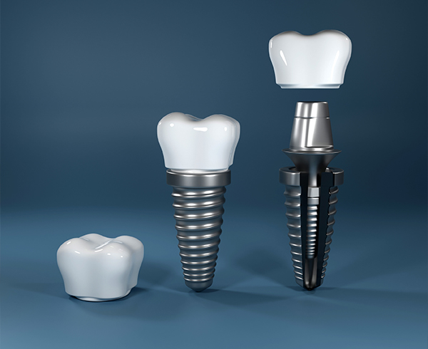 İmplant Tedavisi